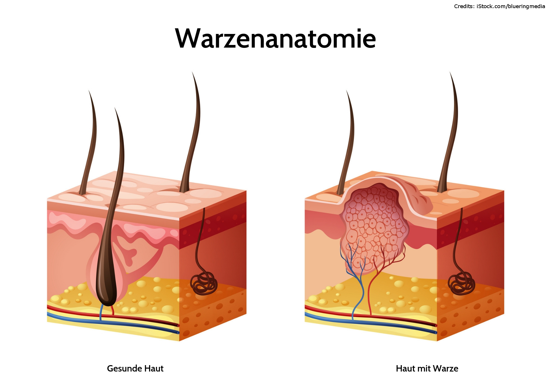 Hühnerauge oder warze